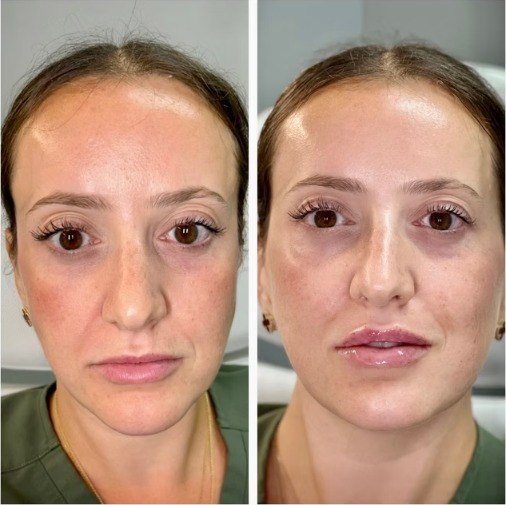 Before and after fillers