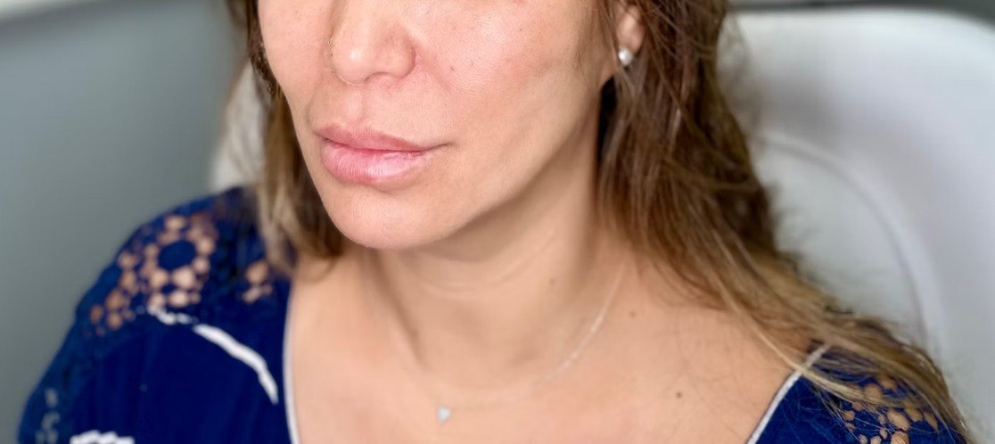 Before and after filler